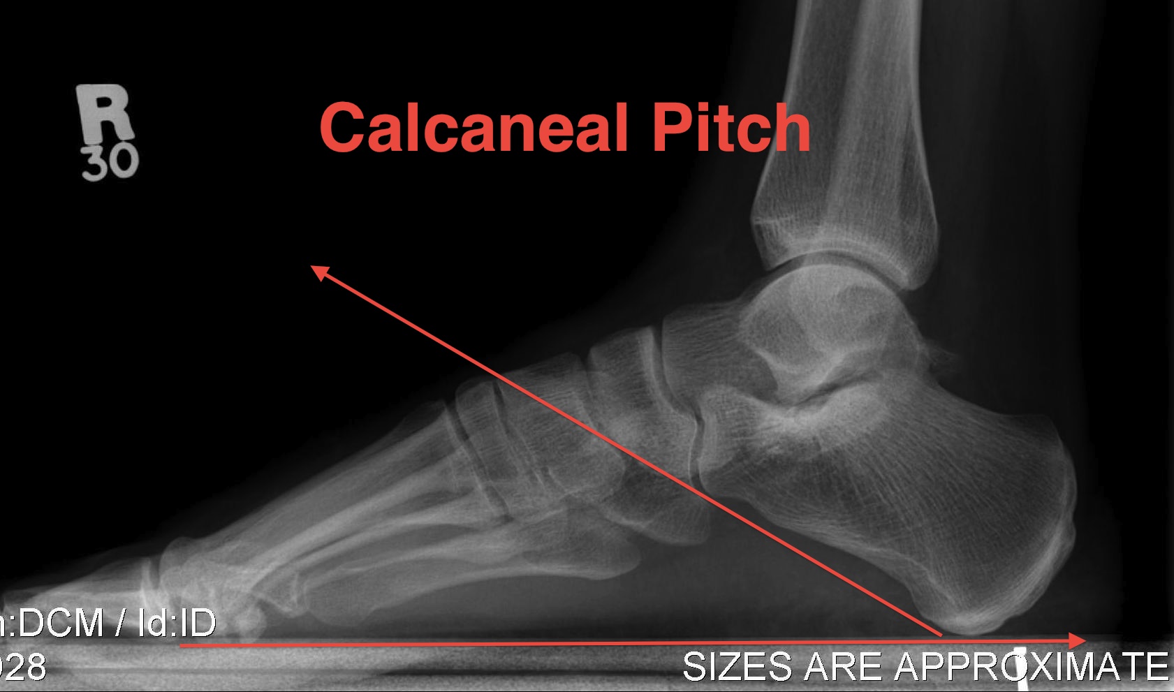 Calcaneal Pitch